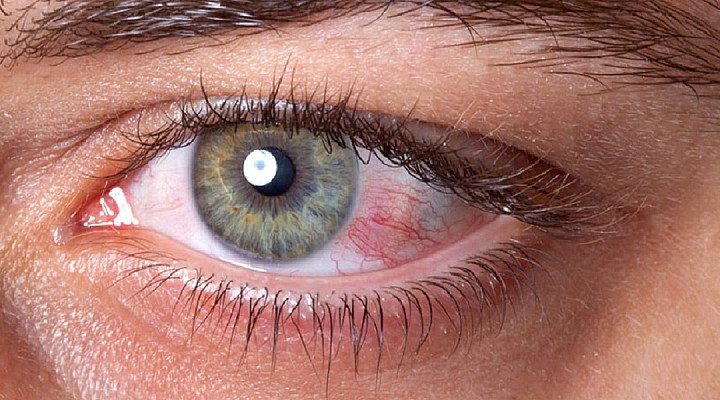 Glaucoma, una malattia subdola ma che può essere almeno contenuta (la storia)