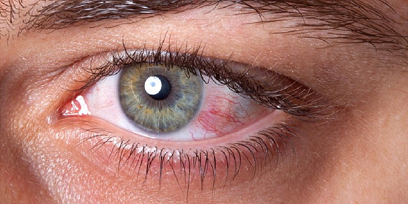 Glaucoma, una malattia subdola ma che può essere almeno contenuta (la storia)