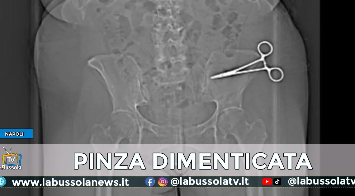 Dopo 7 mesi, rimossa la pinza “dimenticata” nella pancia….