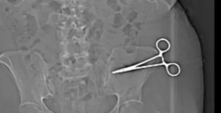 Dopo 7 mesi, rimossa la pinza “dimenticata” nella pancia….