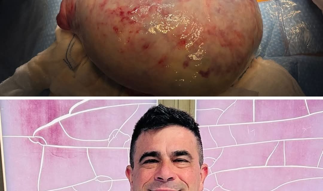 Massa gigante nell’addome: donna potentina salvata dal professore Mario Polichetti